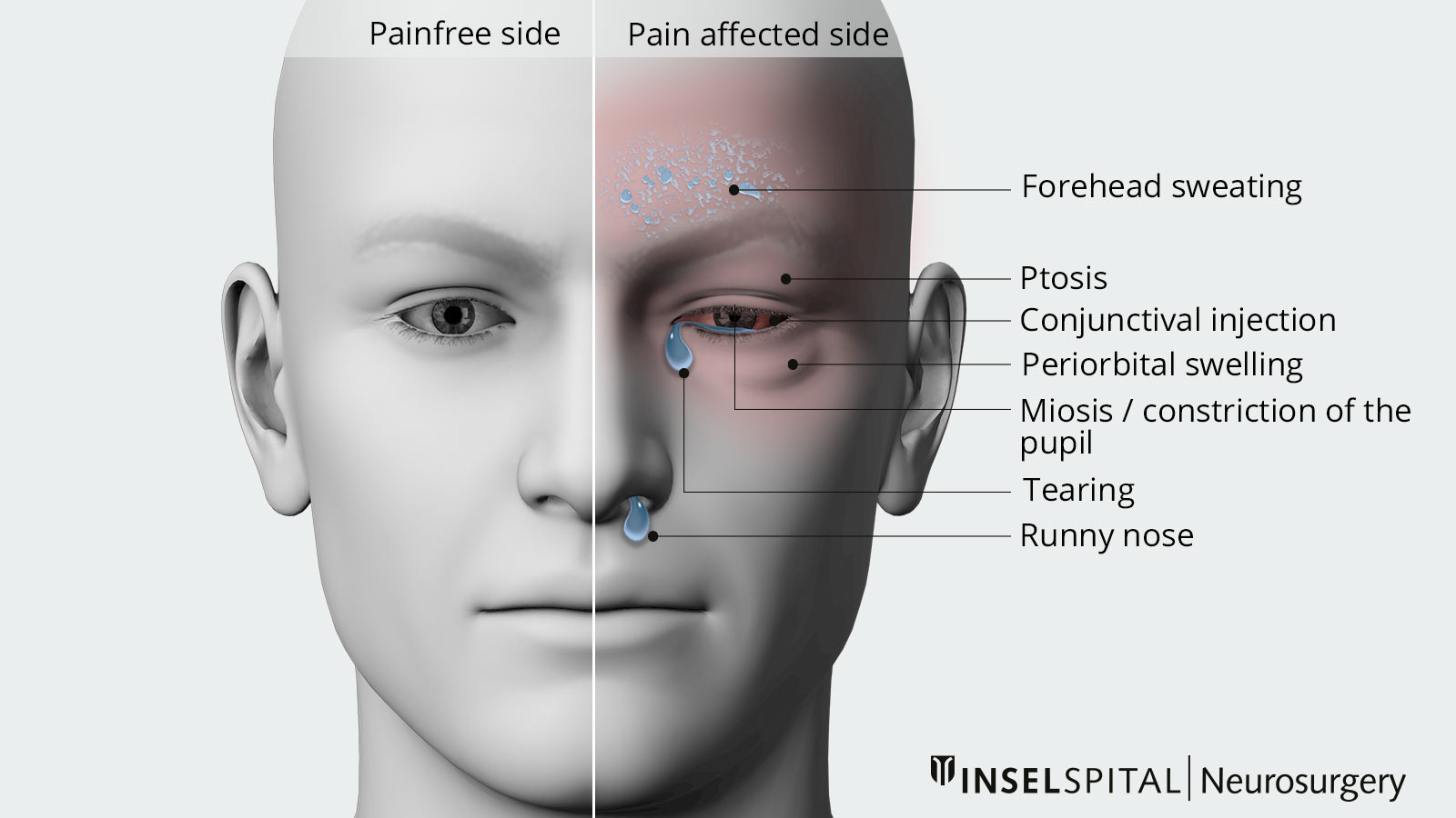 2-part facial drawing. Accompanying symptoms of cluster headaches are drawn in one half.