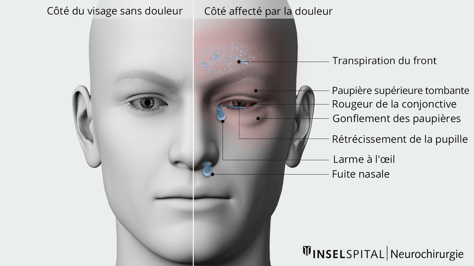 Dessin du visage en 2 parties. Dans une moitié sont dessinés les symptômes accompagnant les céphalées en grappe.