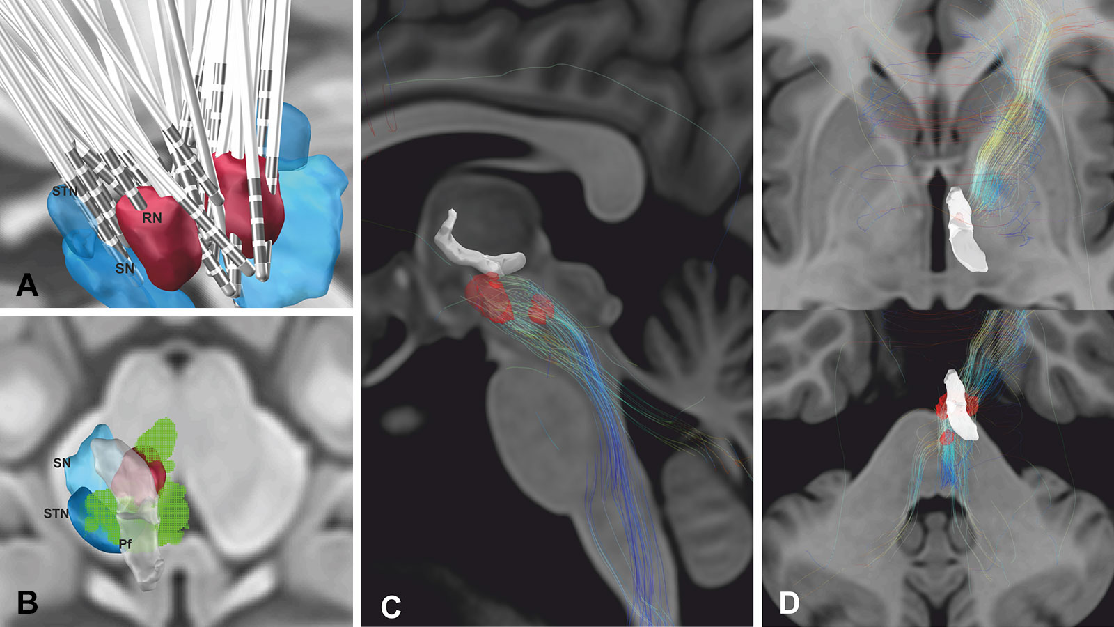 4-part illustration shows electrode position and effective stimulation fields of DBS for cluster headaches