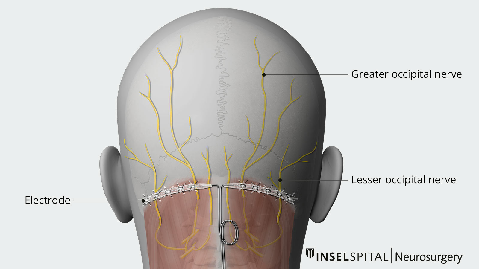 Overview drawing of occipital nerve stimulation with electrode position and nerves