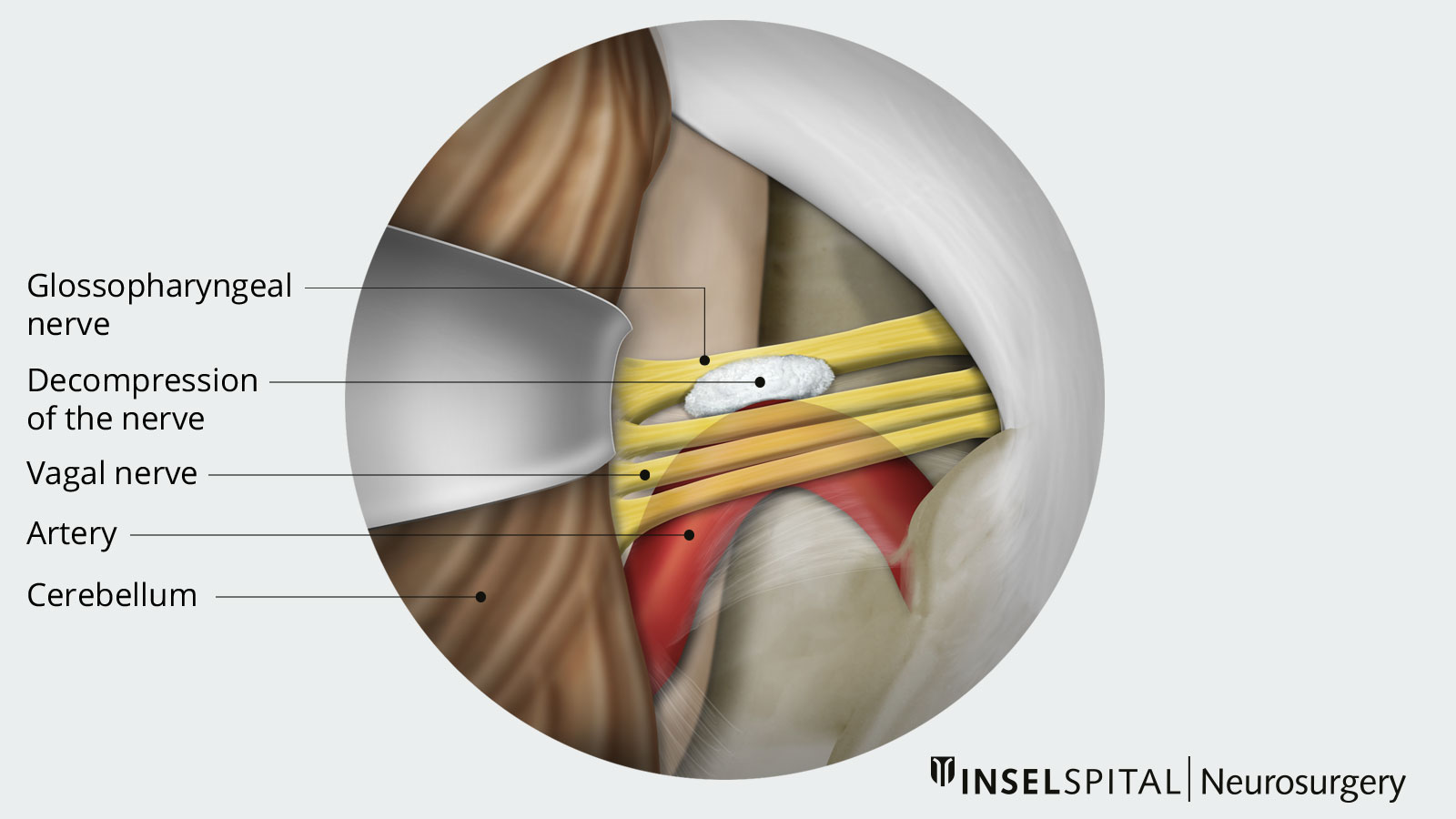 Overview drawing of neurovascular decompression with the help of a Teflon cushion