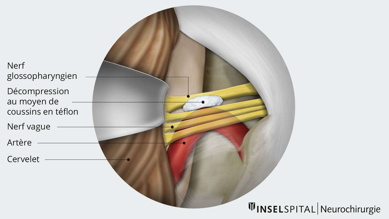 Vue d'ensemble de la décompression neurovasculaire à l'aide d'un coussin de téflon