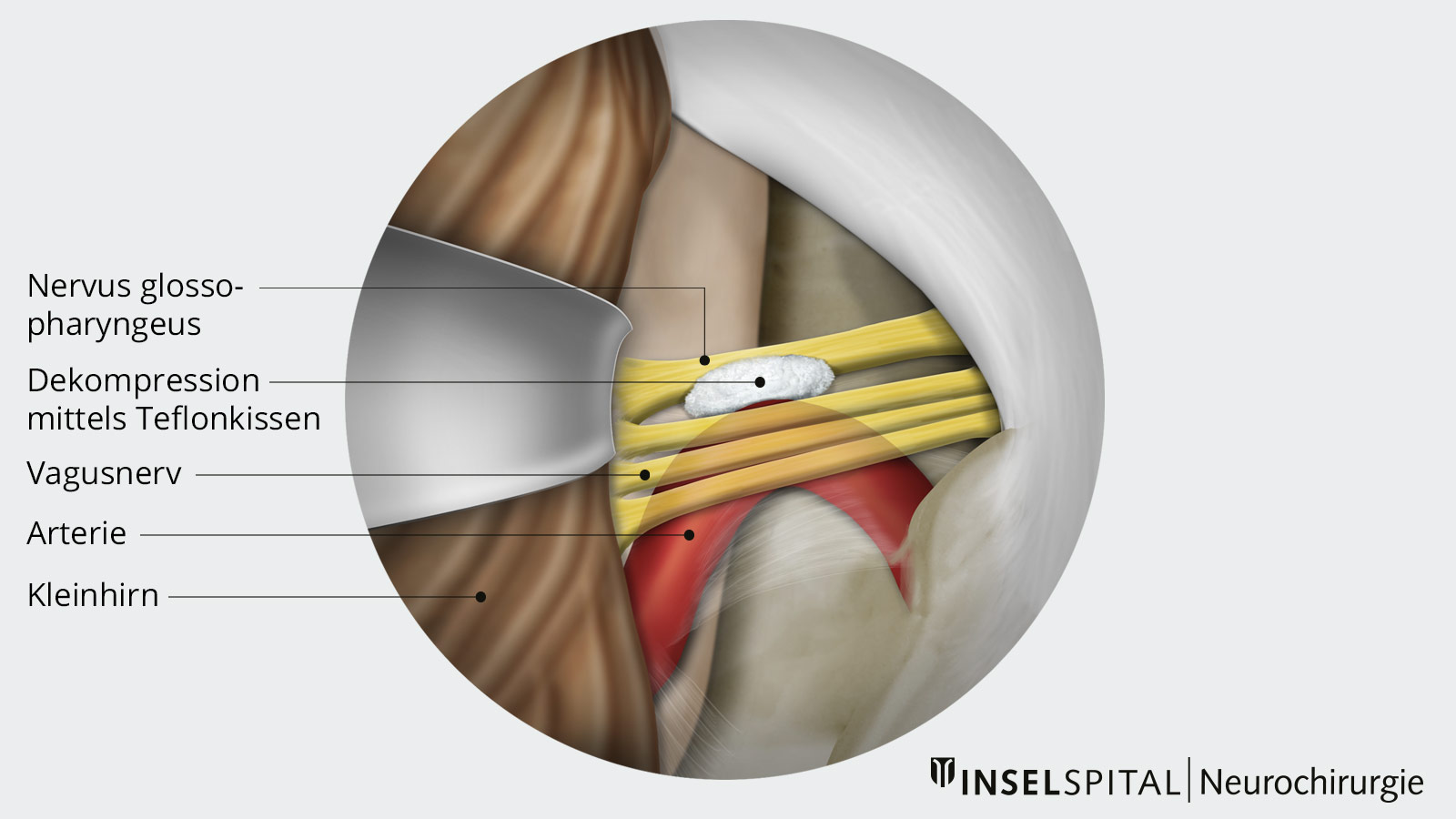 Übersichtszeichnung zur neurovaskulären Dekompresson mit Hilfe eines Teflonkissens