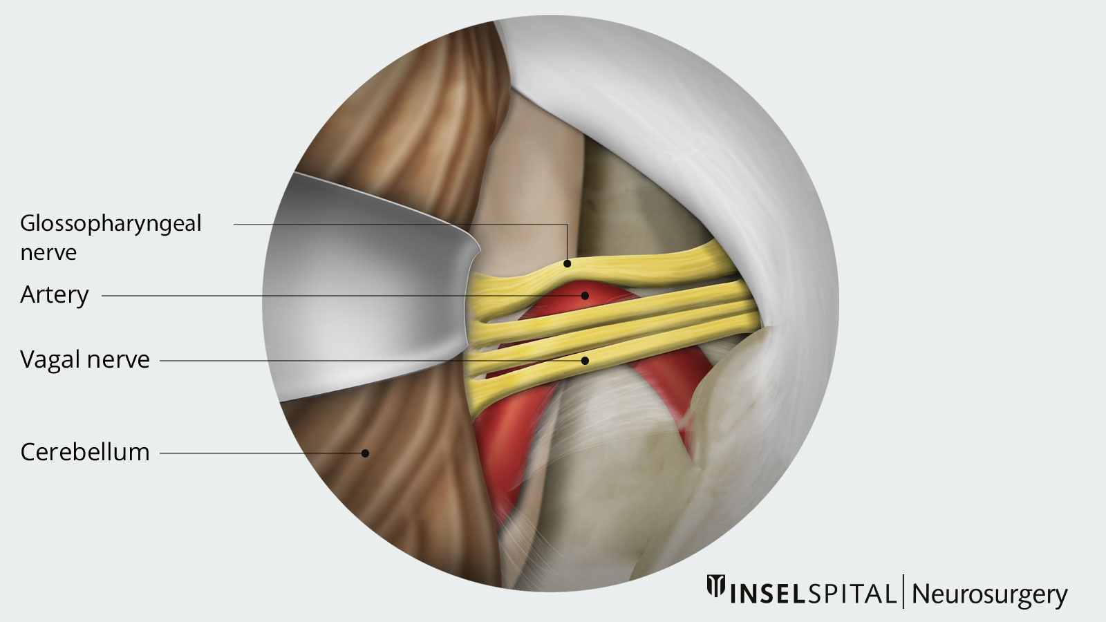 Schematic drawing of a neurovascular conflict.