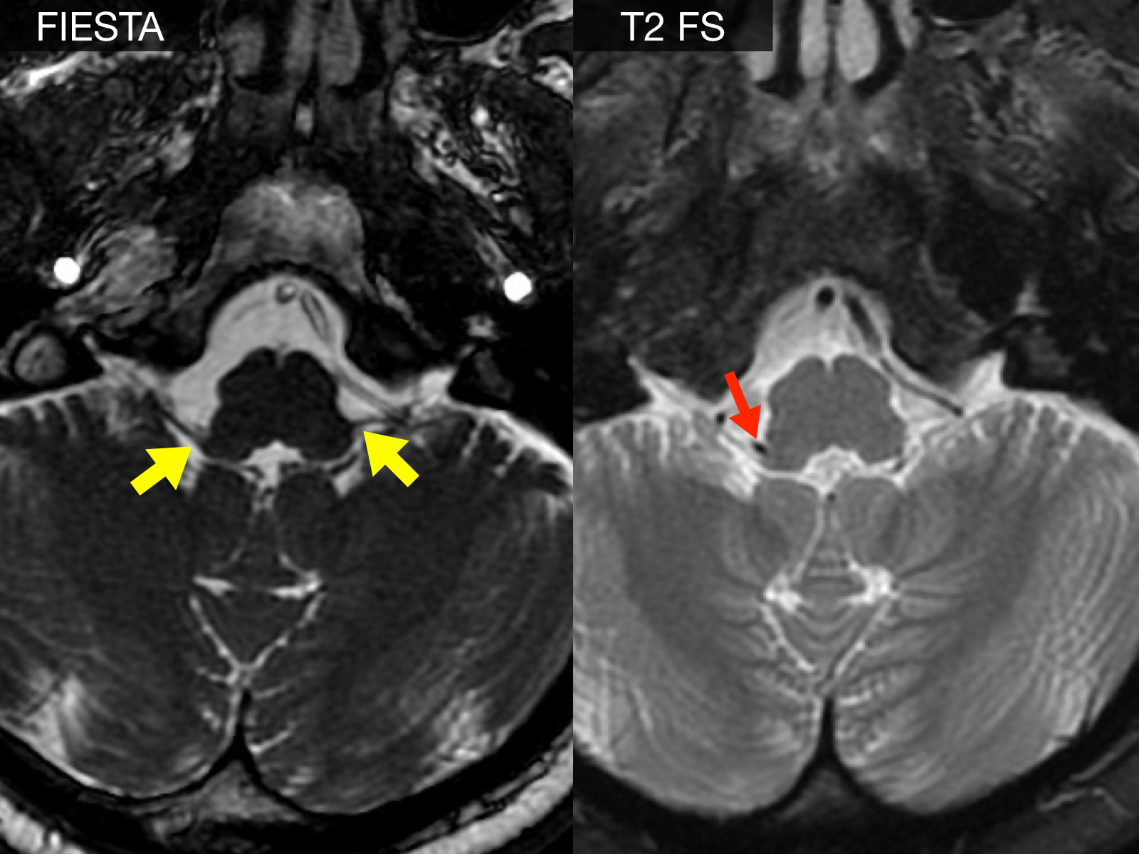 IRM du crâne avec marquage du conflit neurovasculaire