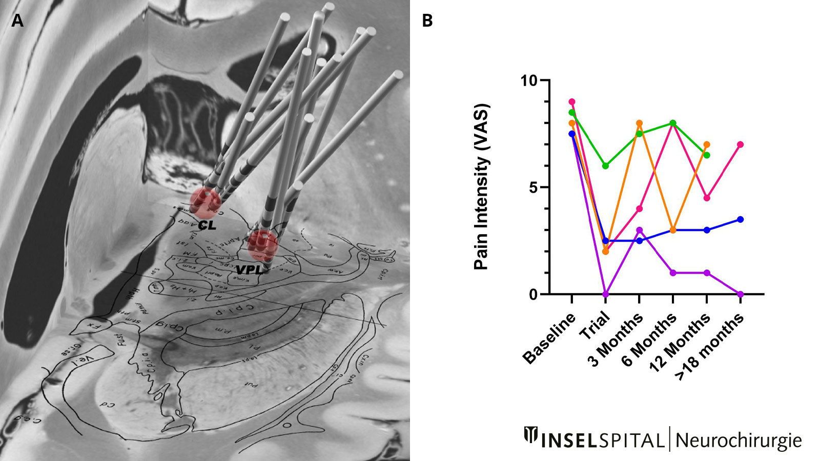 Pain relief by DBS. Left representation of the electrodes, right graph of pain intensity over time.