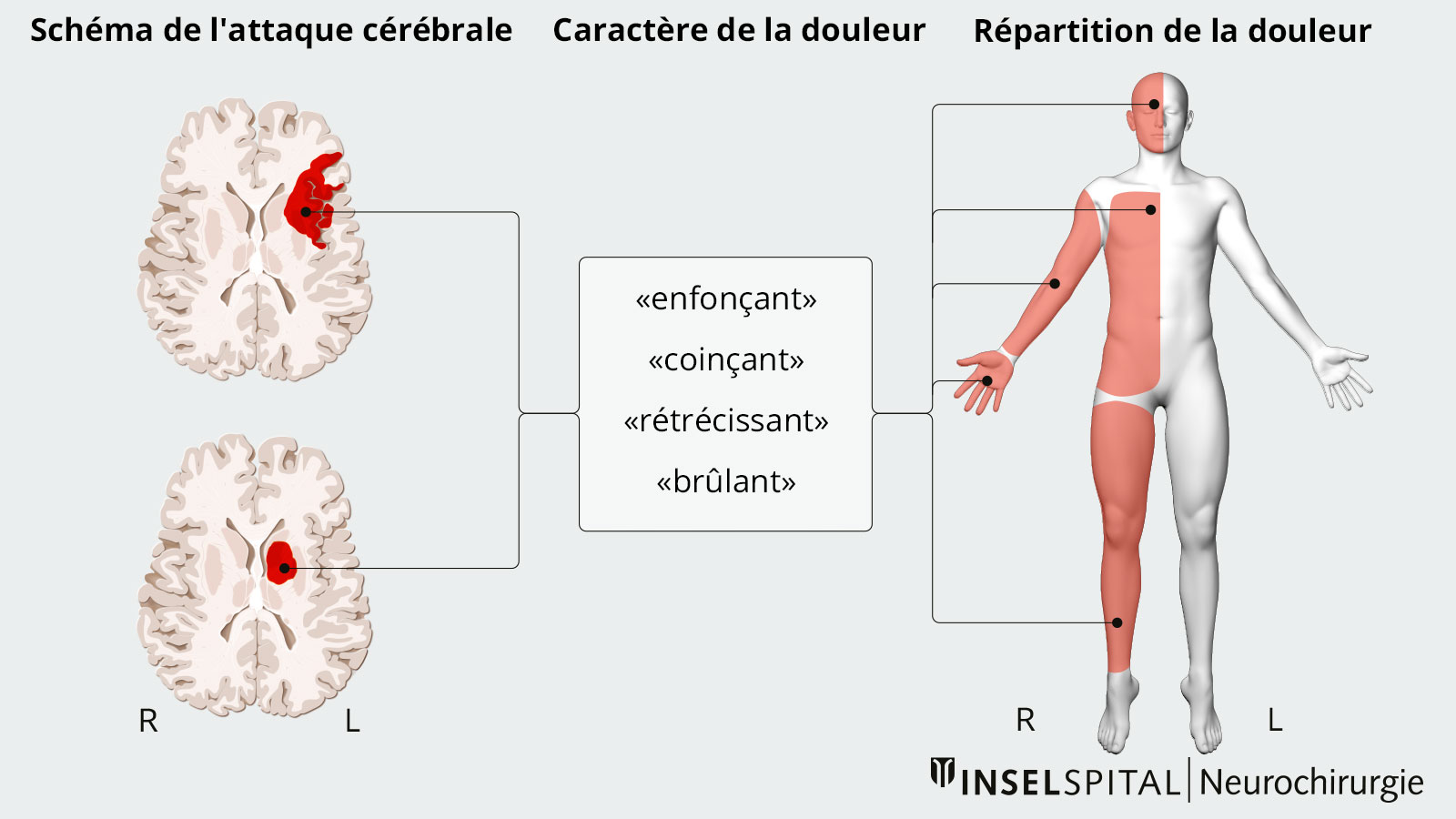 Dessin d'une douleur neuropathique avec schéma de l'attaque, caractère de la douleur et répartition de la douleur.