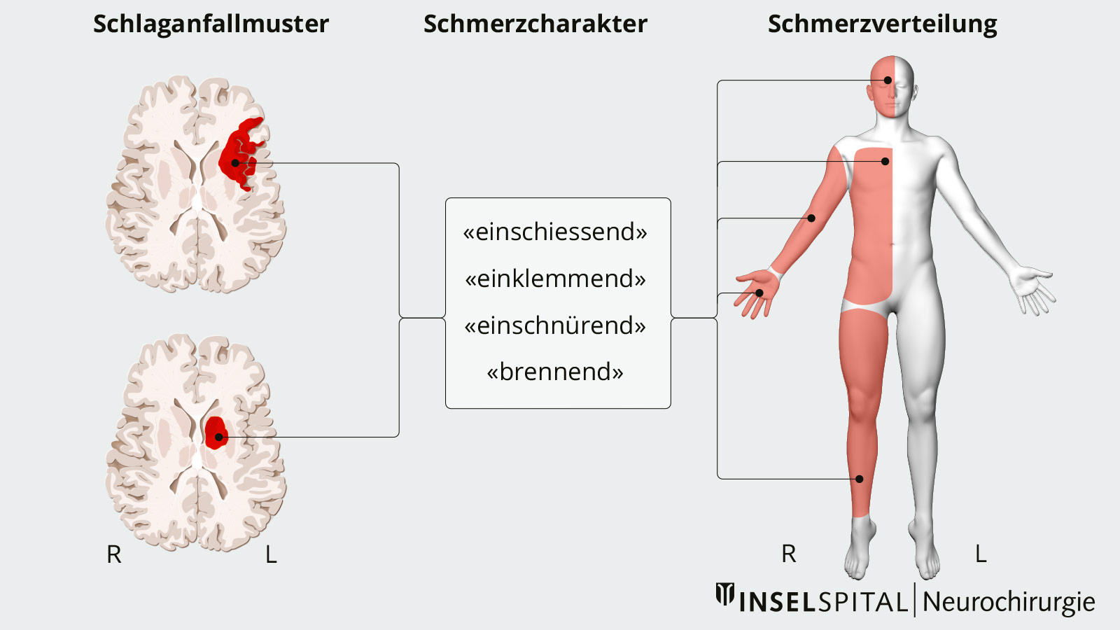 Zeichnung des neuropathischen Schmerzes mit Schlaganfallmuster, Schmerzcharakter und Schmerzverteilung.