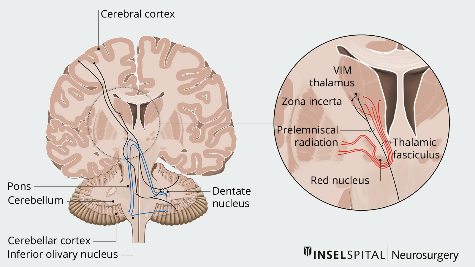 This illustration of essential tremor depicts the signaling pathways involved in tremor formation, as well as the target points for brain stimulation.