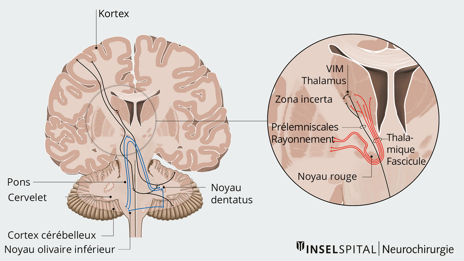 Cette illustration du tremblement essentiel montre les voies de signalisation impliquées dans la formation du tremblement, ainsi que les points cibles de la stimulation cérébrale.