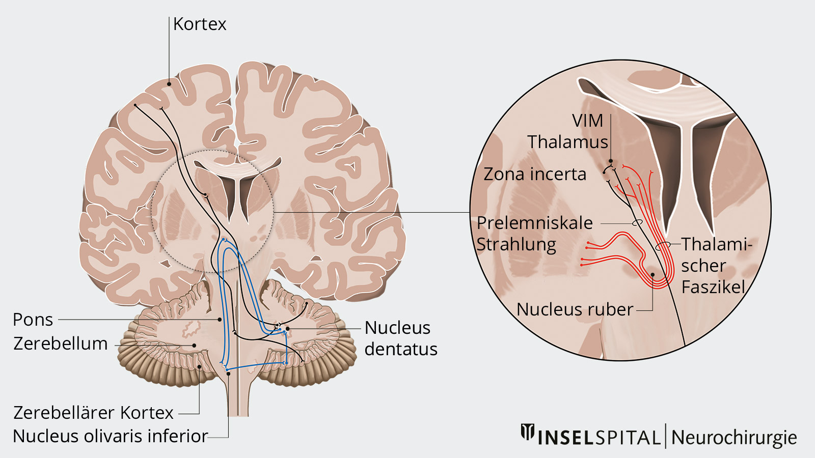 Diese Zeichnung zum essenziellen Tremor zeigt die Signalwege, die an der Tremorentstehung beteiligt sind, sowie die Zielpunkte der Hirnstimulation.