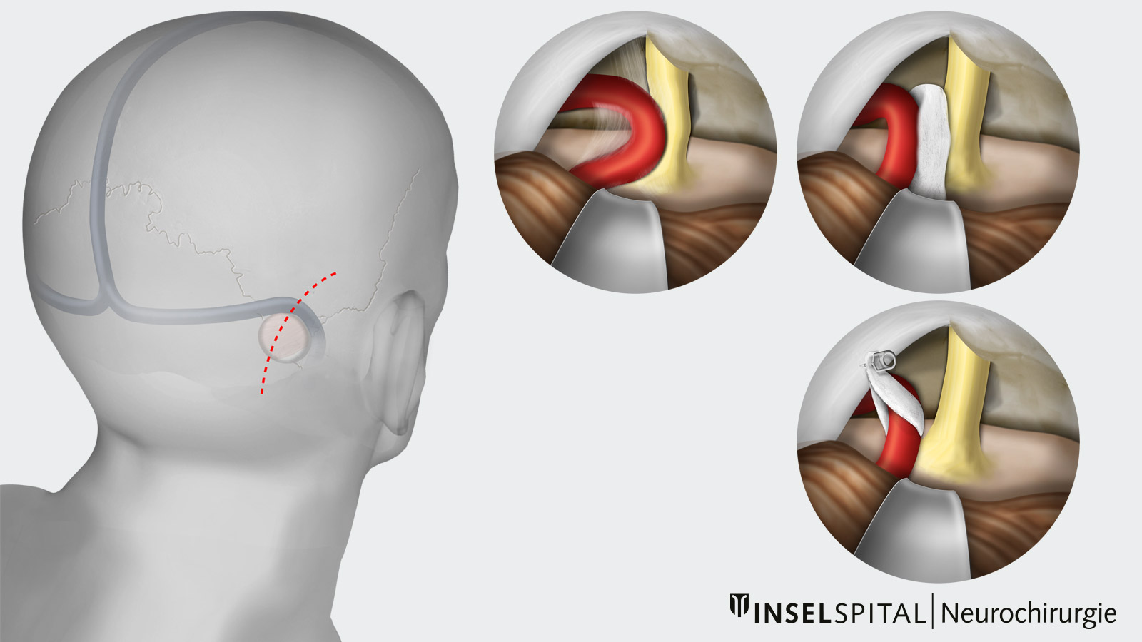 The drawing shows a microvascular decompression according to Jannetta