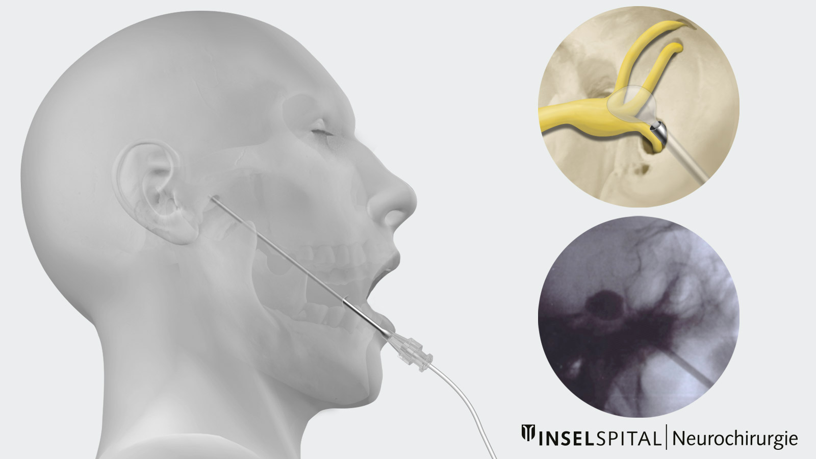 Drawing of a balloon compression with probe access through the cheek