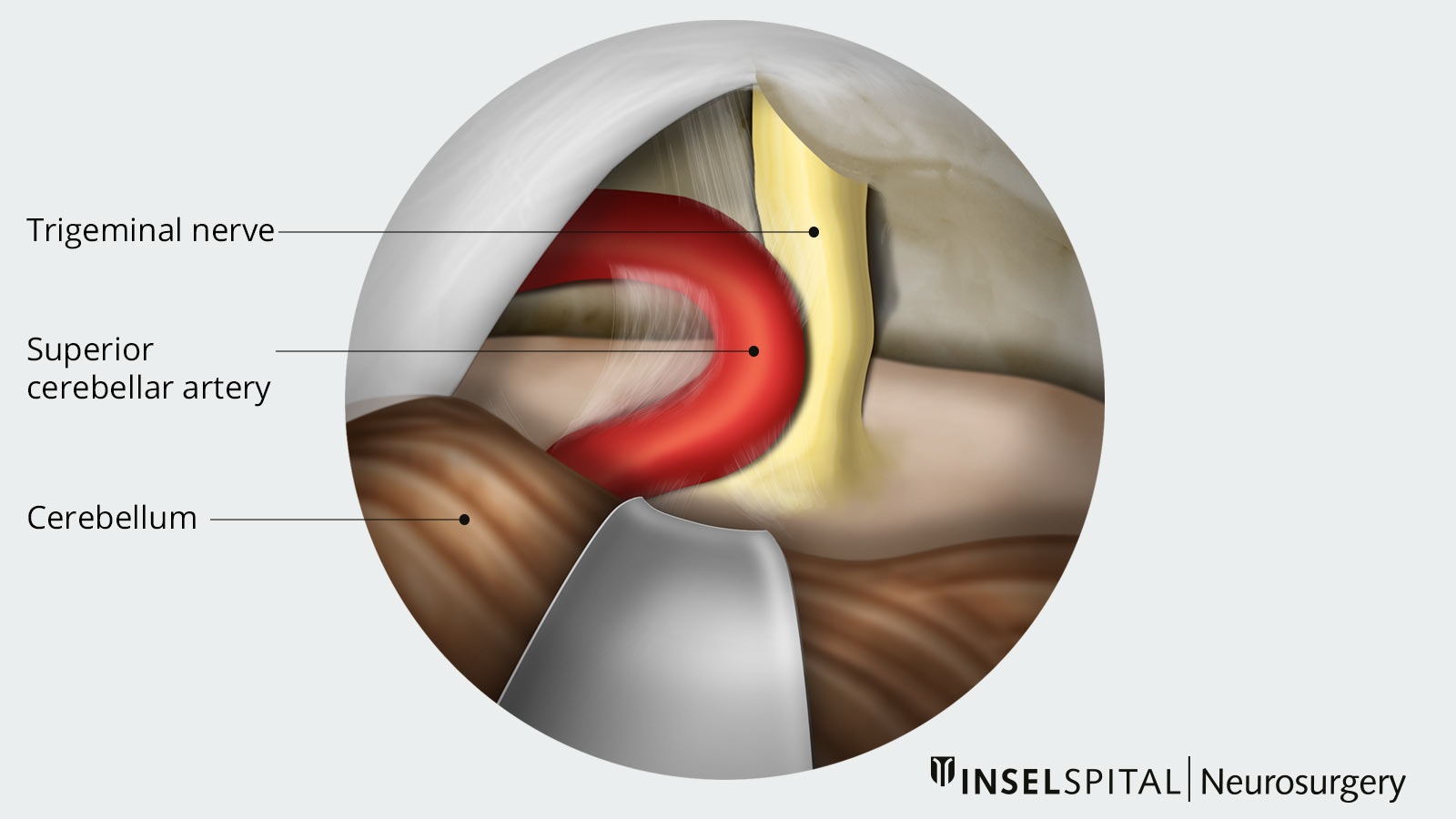 The drawing shows how a blood vessel compresses and displaces the trigeminal nerve.