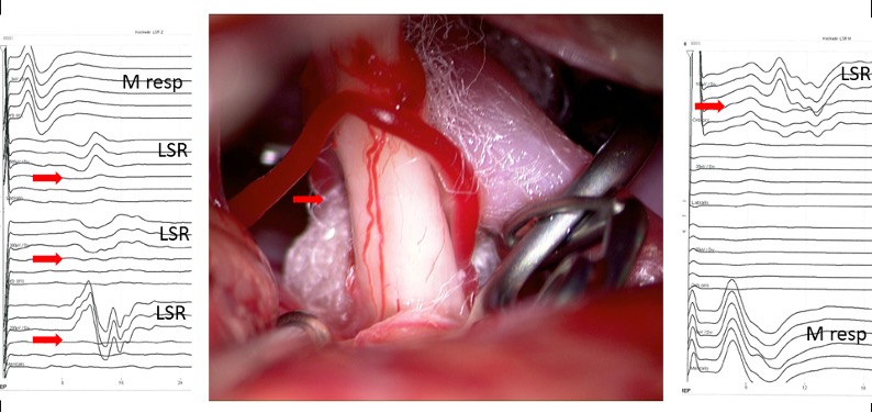 ​Operation eines Hemispasmus facialis mit Lateral Spread Testung (LSR)