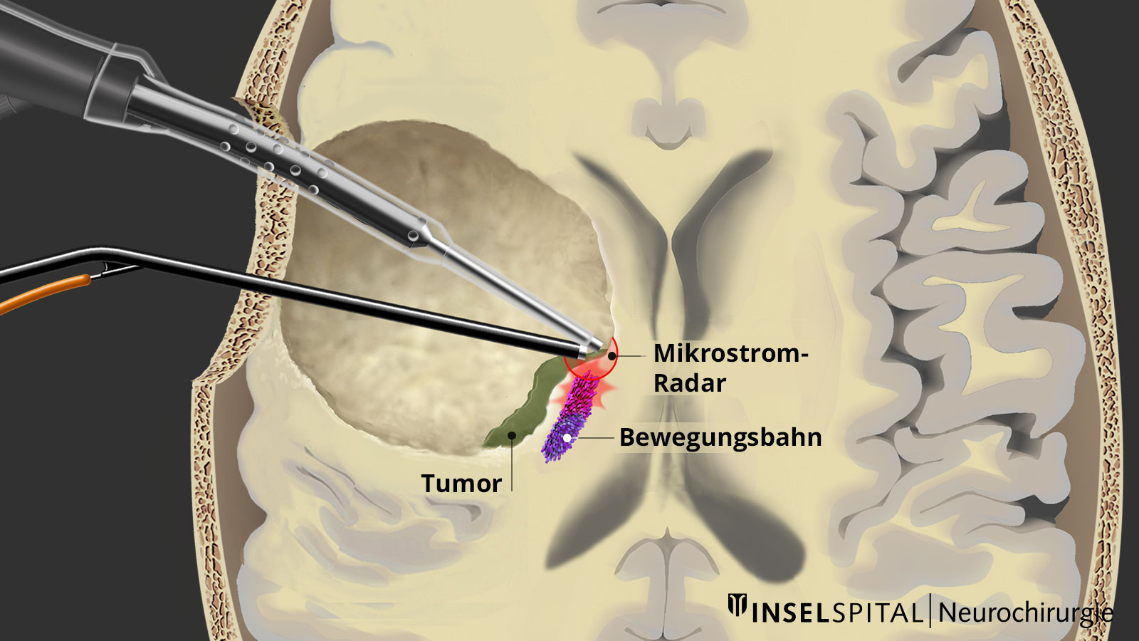 ​Zeichnung mit Hybridsonde, Tumor, Bewegungsbahn und Mikrostromradar