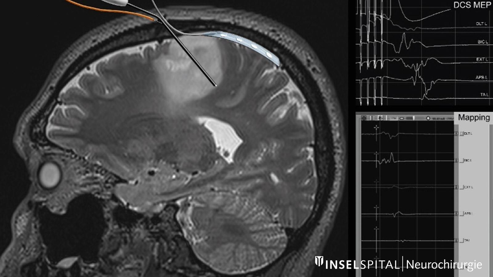 MRI-Bild mit eingezeichnetem Neuromonitoring