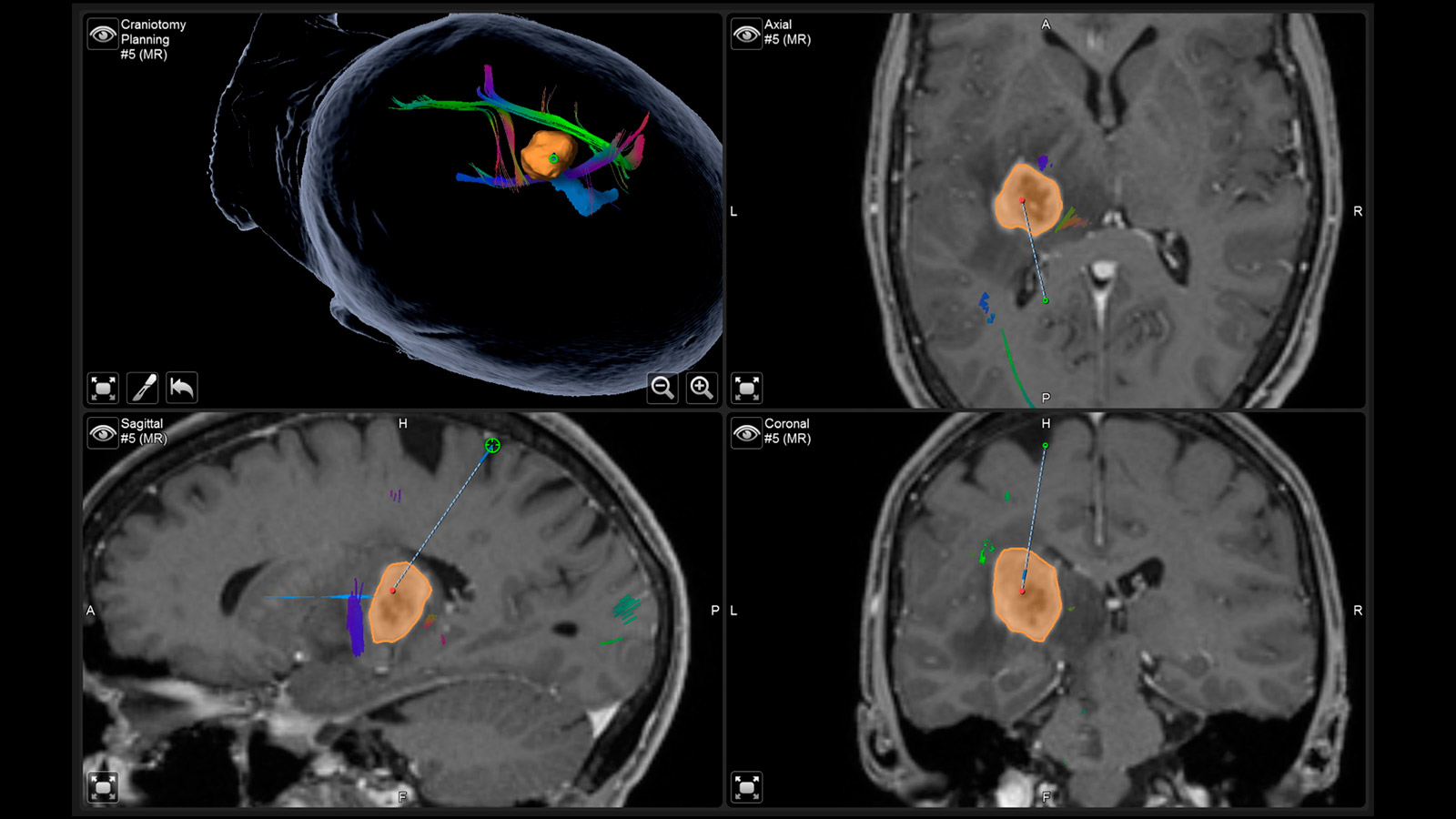 4 skull images with superimposed structures