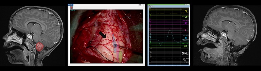 Three-part illustration for safe tumor removal by searching for a tumor access without damaging the cranial nerves