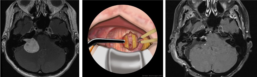 Tumor surgery with mapping in 3 images: before, during and after surgery