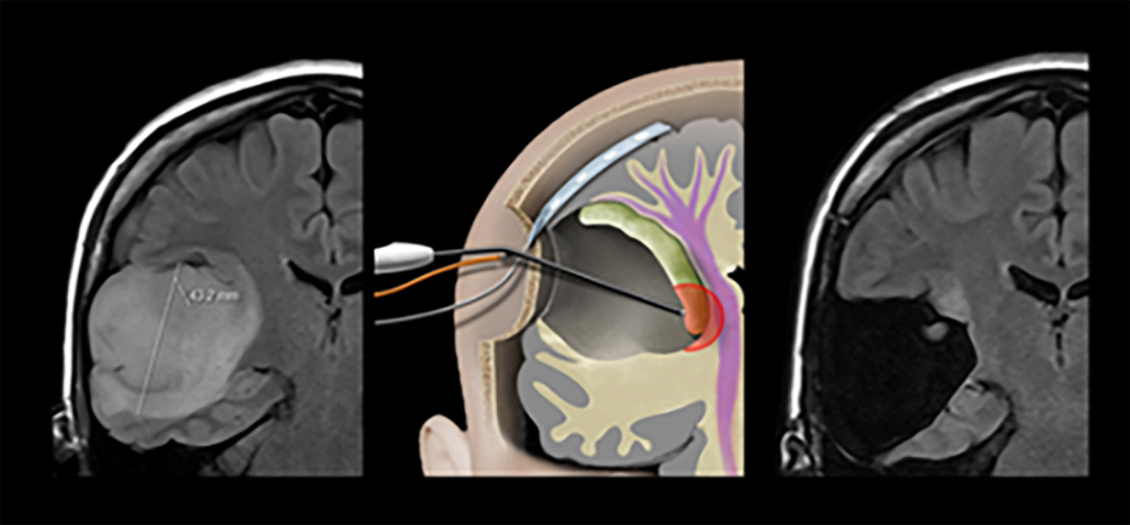 Three-part illustration: left MRI before tumor surgery, center drawing neuromonitoring, right MRI after tumor surgery with residual tumor that was not removed due to neuromonitoring