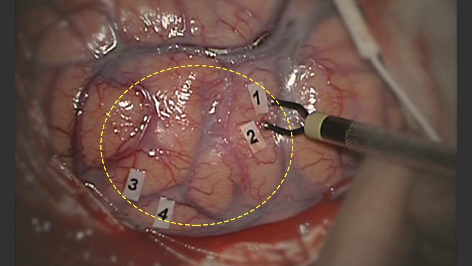 Surgical photo of tumor, probe and markers of speech-relevant areas