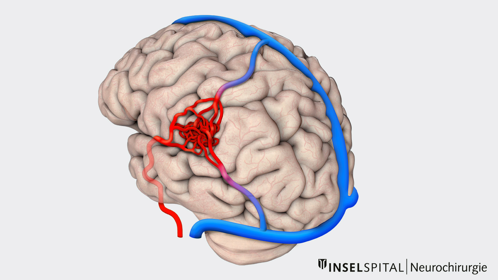 ​Zeichnung einer AVM. Blutzuführende Arterien in rot sind in einem Knäuel von Gefässen direkt mit blutableitenden Venen in blau verbunden.