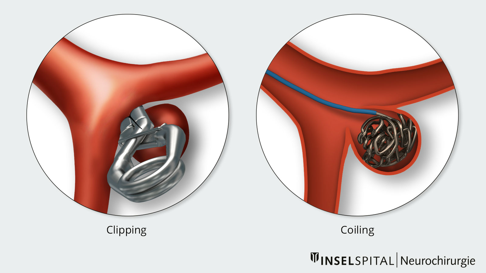 Comparison of clipping and coiling
