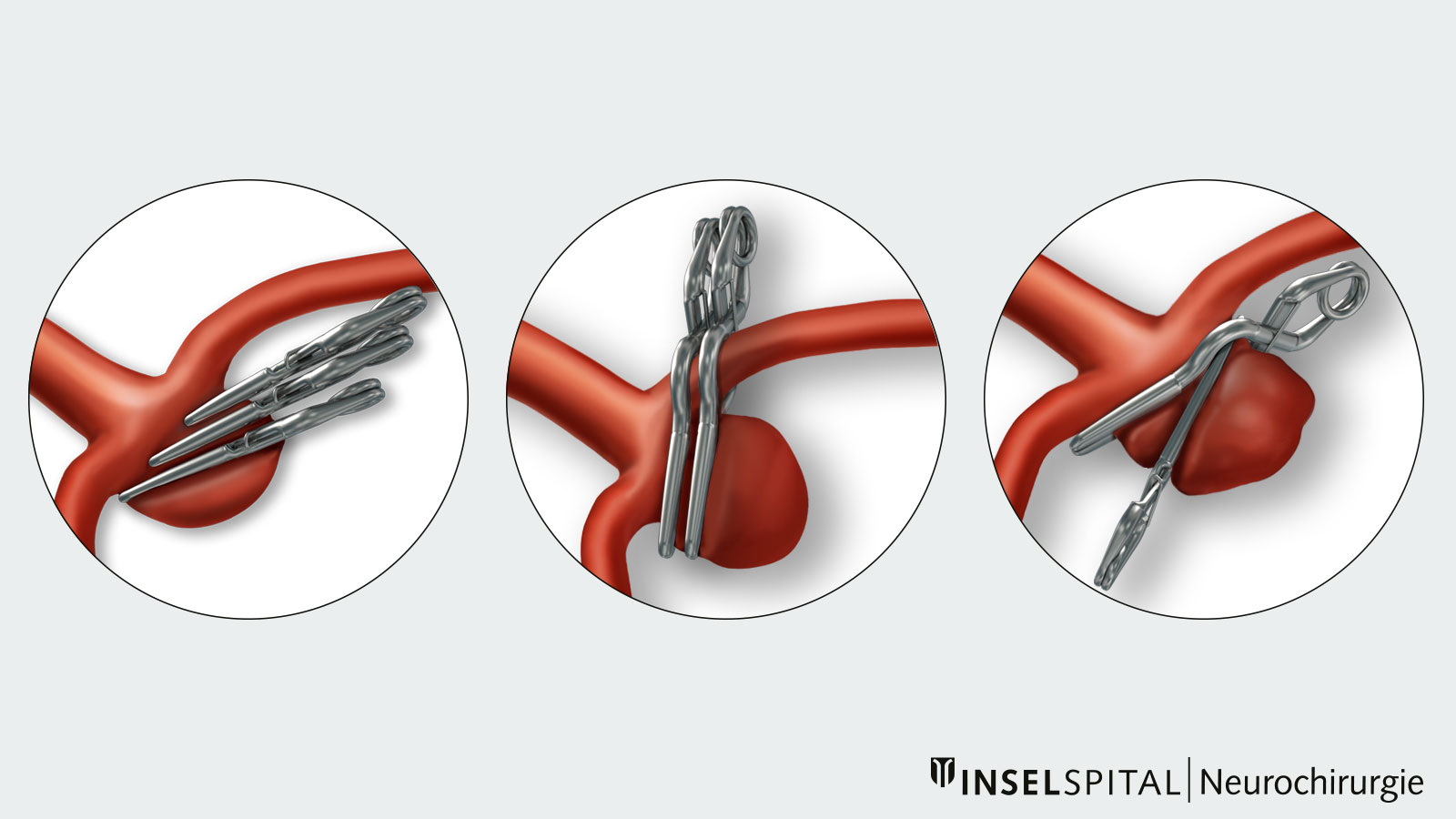 Drawing of various aneurysm clips
