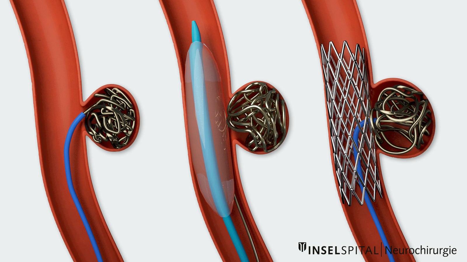 Drawing showing coiling variants: with coils only, with coils and balloon, with coils and stent