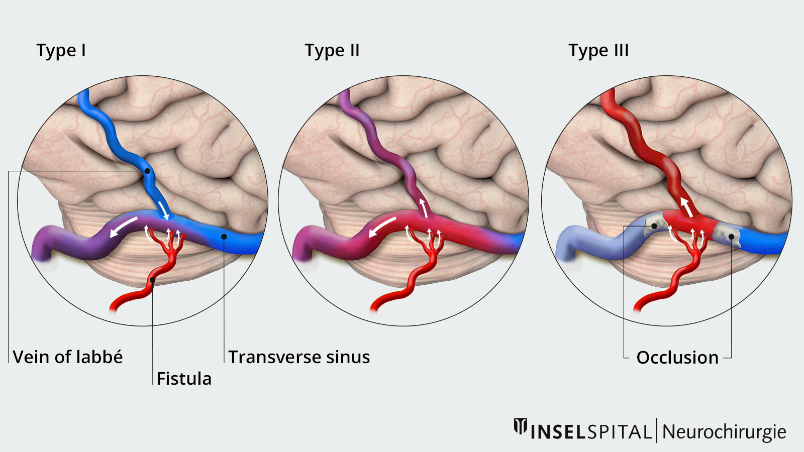 Three-part color drawing of Borden type I, II and III