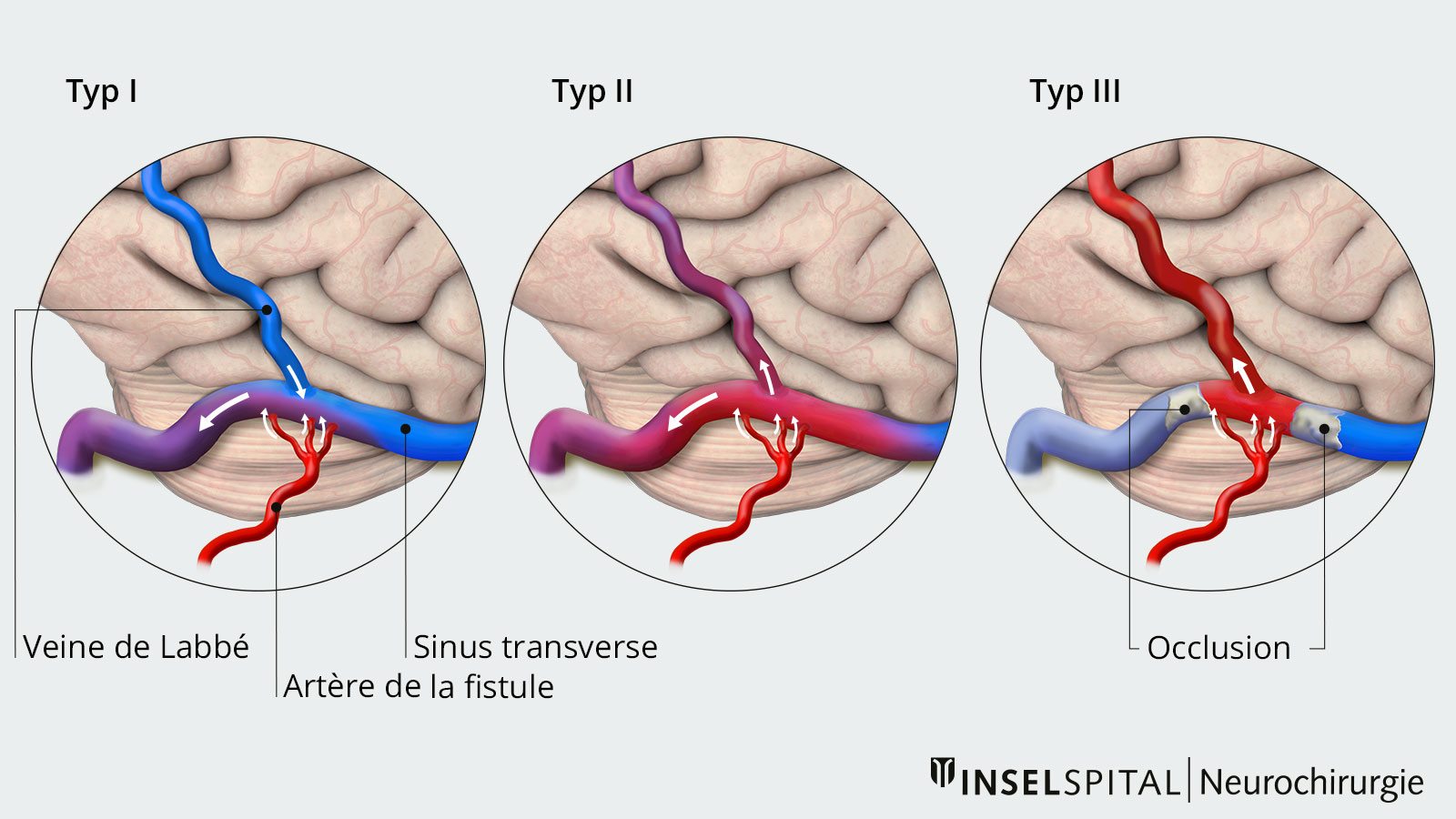 Dessin en couleur en trois parties de Borden type I, II et III