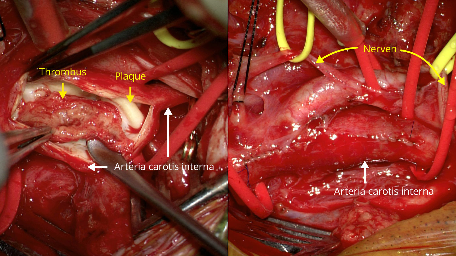 Zwei OP-Fotos nebeneinander. Links Thrombus in der Halsschlagader, rechts Bild nach OP