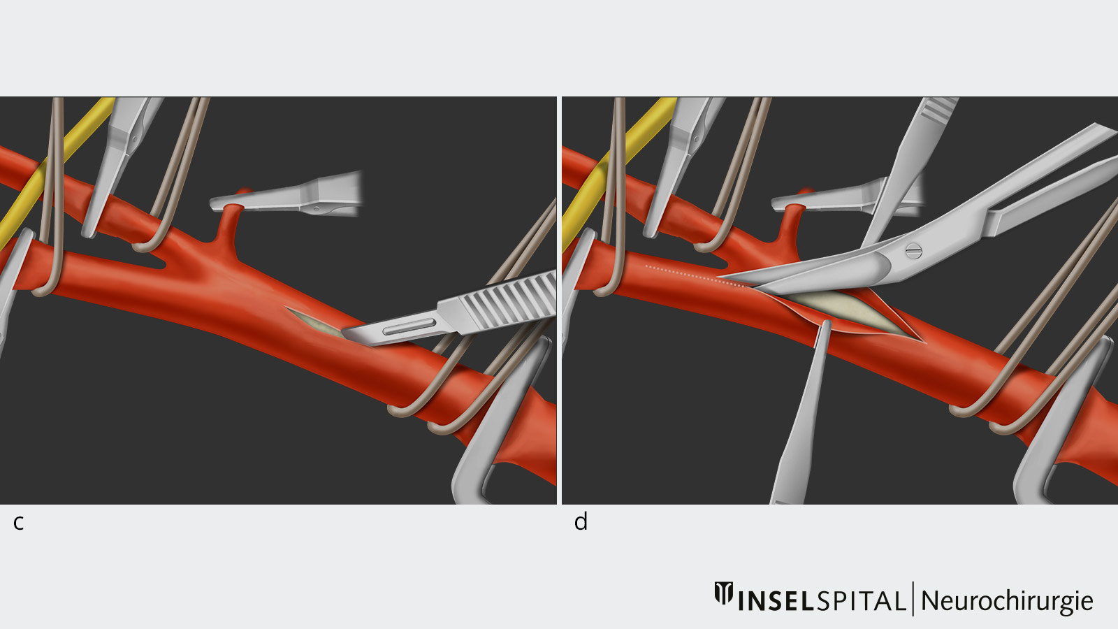 Dessin en 10 parties d'une endartériectomie carotidienne. L'image c Incision de l'artère. L'image d Prolongement de l'incision