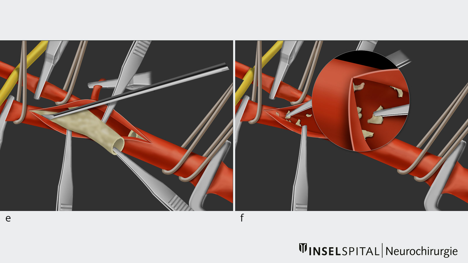 10-part drawing of carotid endarterectomy. Fig. e Detachment of deposits. Fig. f Removal of microparticles.