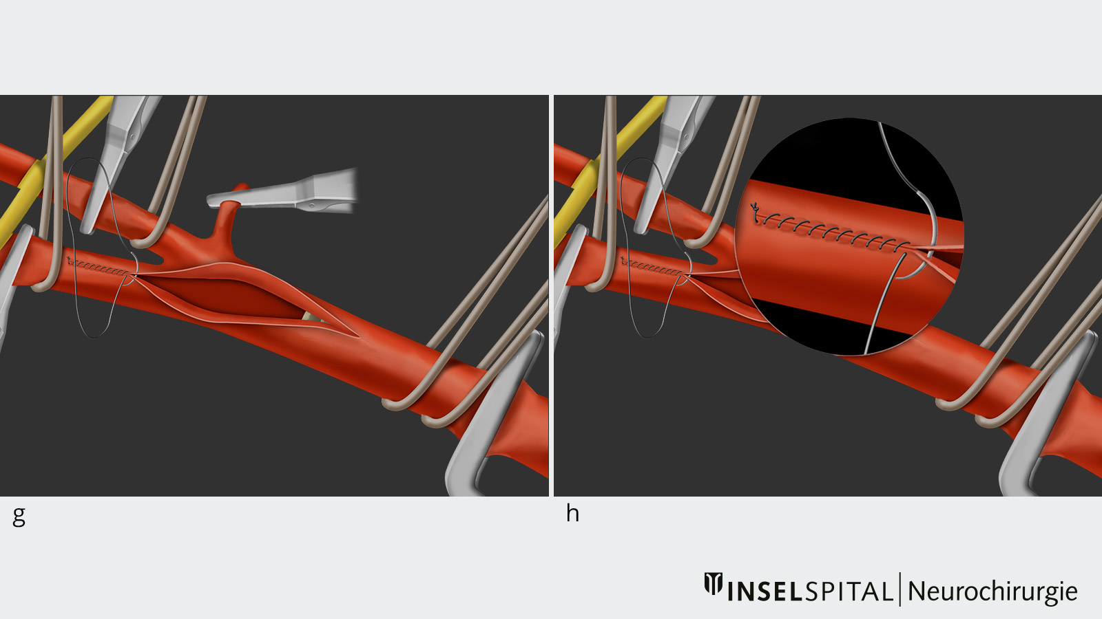 10-part drawing of carotid endarterectomy. Fig g Arterial occlusion. Fig h Close-up of the suture.