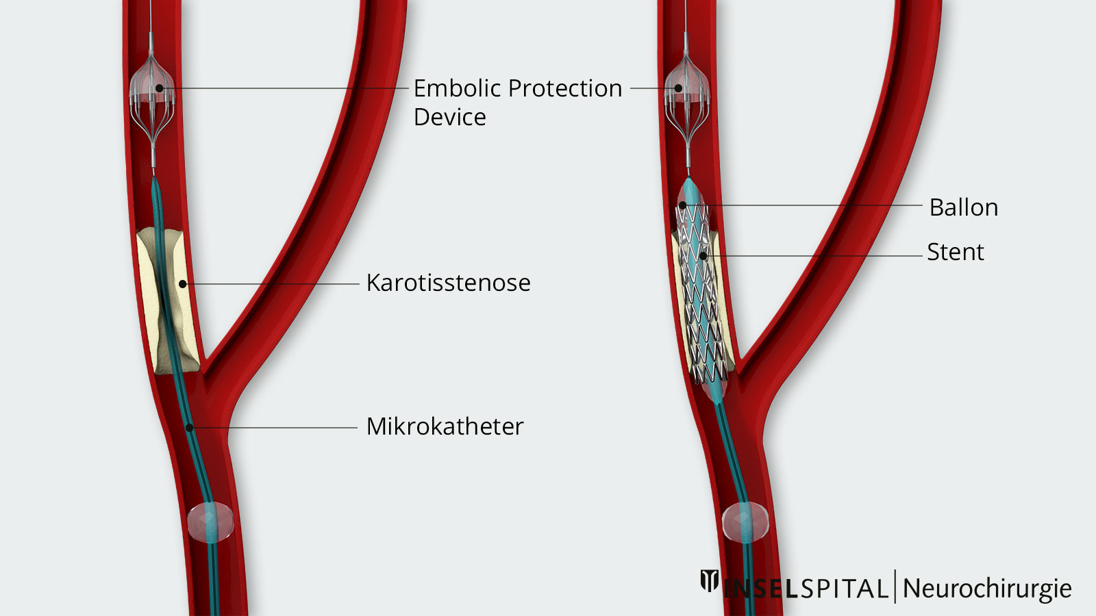 Zeichnung einer Stent-Dilatation. Links entfaltetes EPD (Embolic Protection Device), rechts Stenteinlage und Ballondilatation