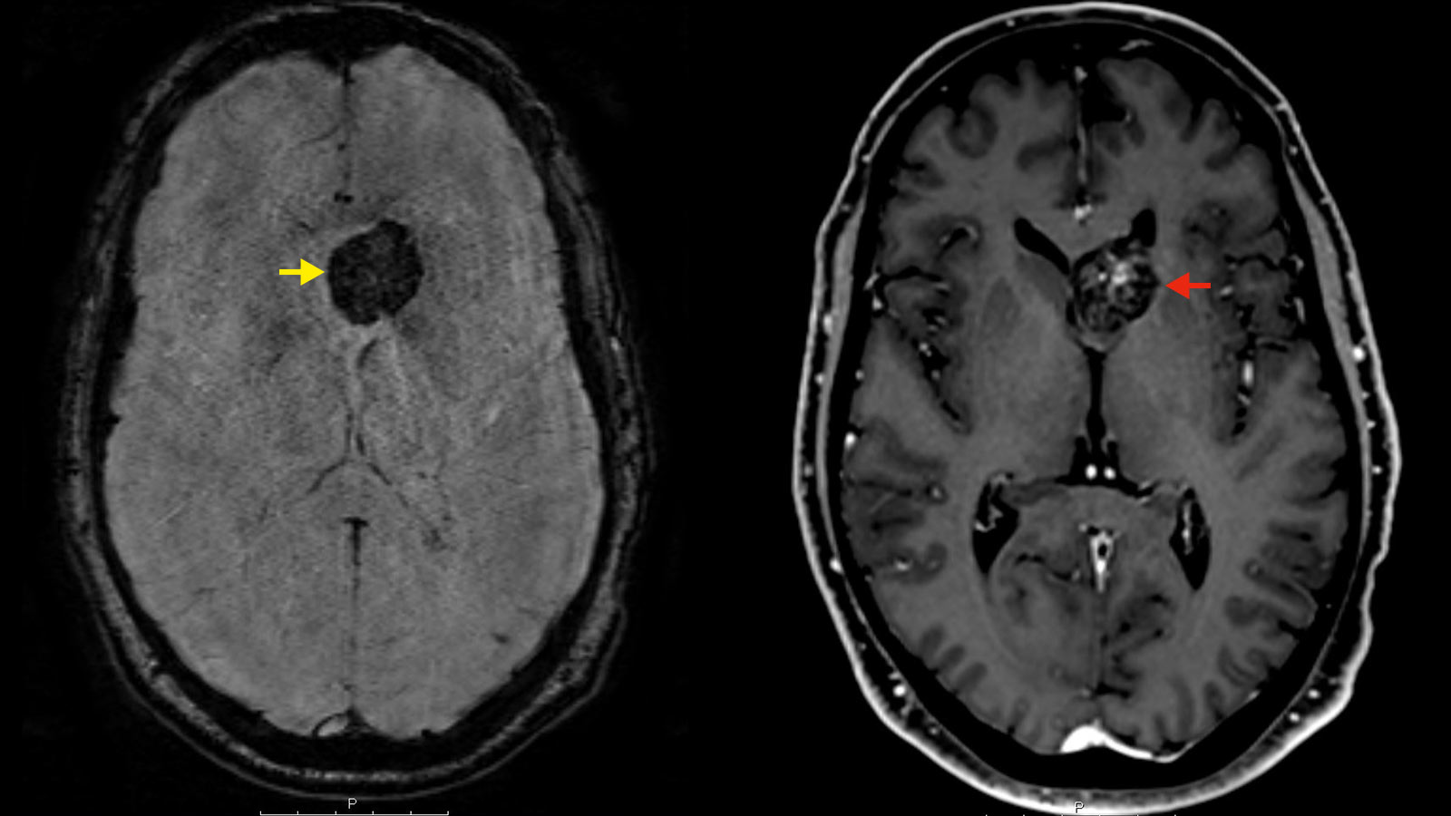 ​Deux images IRM d'un cavernome intraventriculaire placées côte à côte. A gauche, séquence SWI. Le cavernome est marqué d'une flèche jaune et apparaît en noir sur l'image. A droite, séquence assistée par un agent de contraste. Le cavernome est marqué d'une flèche rouge.