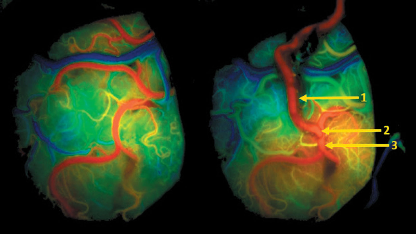 ​Angiografieaufnahme vor und nach der Operation.