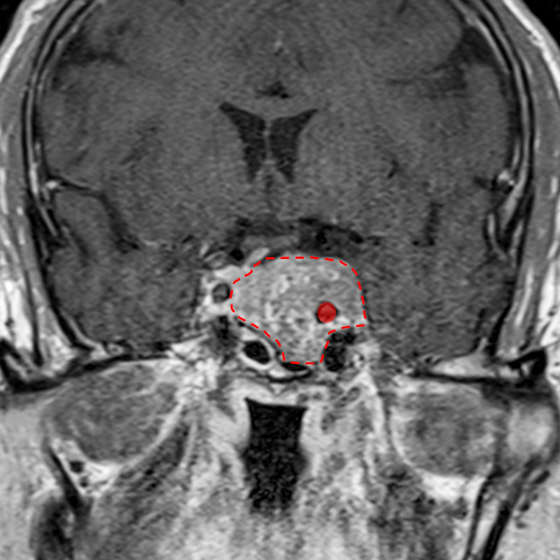 MRT mit Hypophysentumor, der Halsschlagader umschliesst