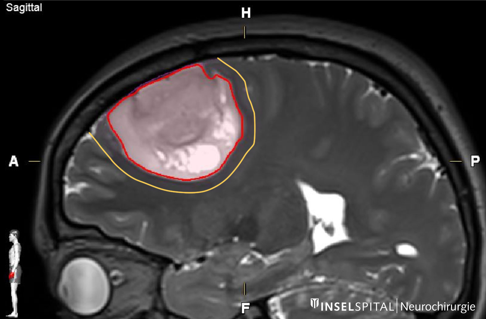 MRI image with markings for supramarginal resection