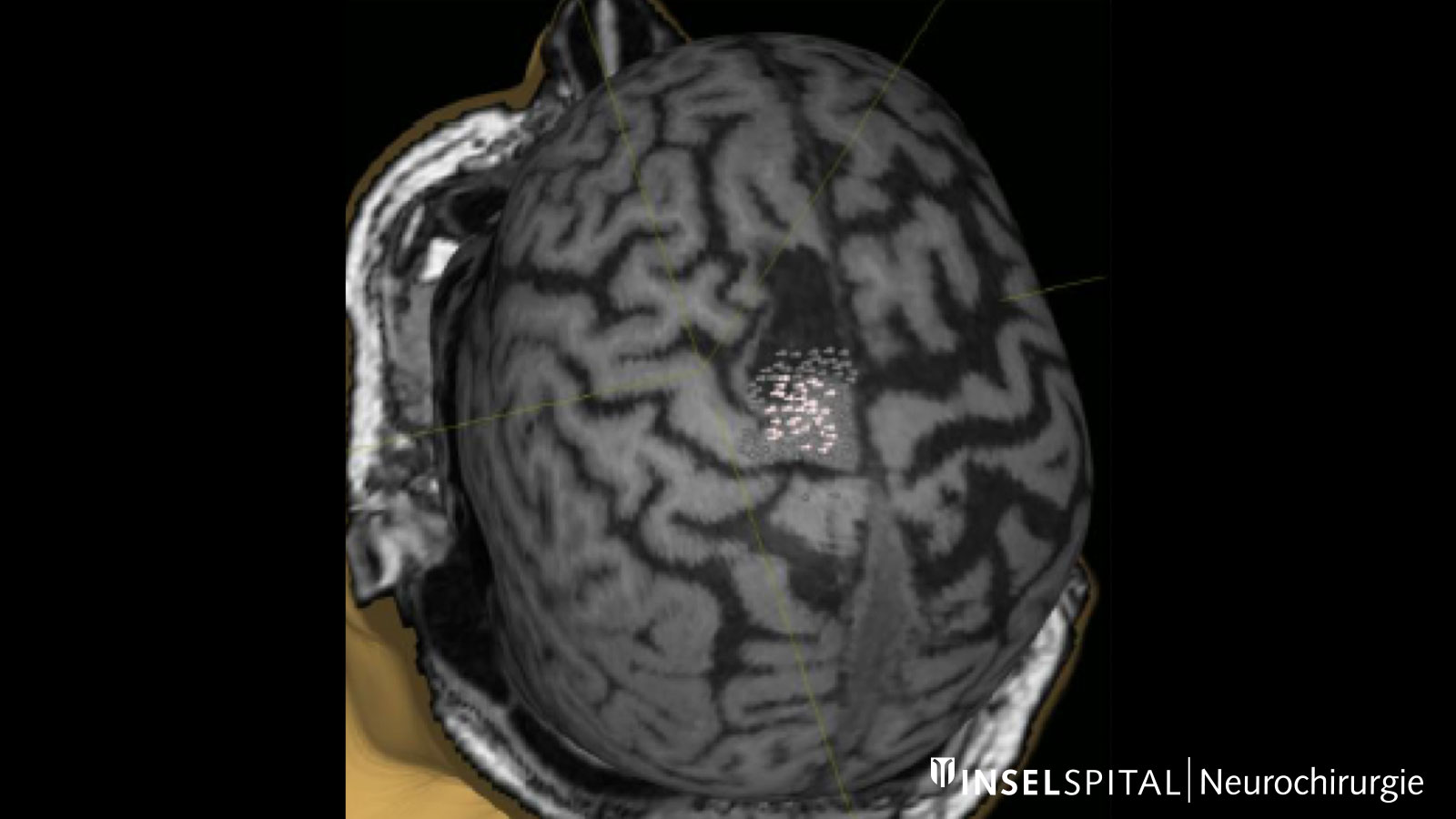 Enregistrement d'une stimulation magnétique transcrânienne naviguée avec des points blancs et gris dans la zone de mesure