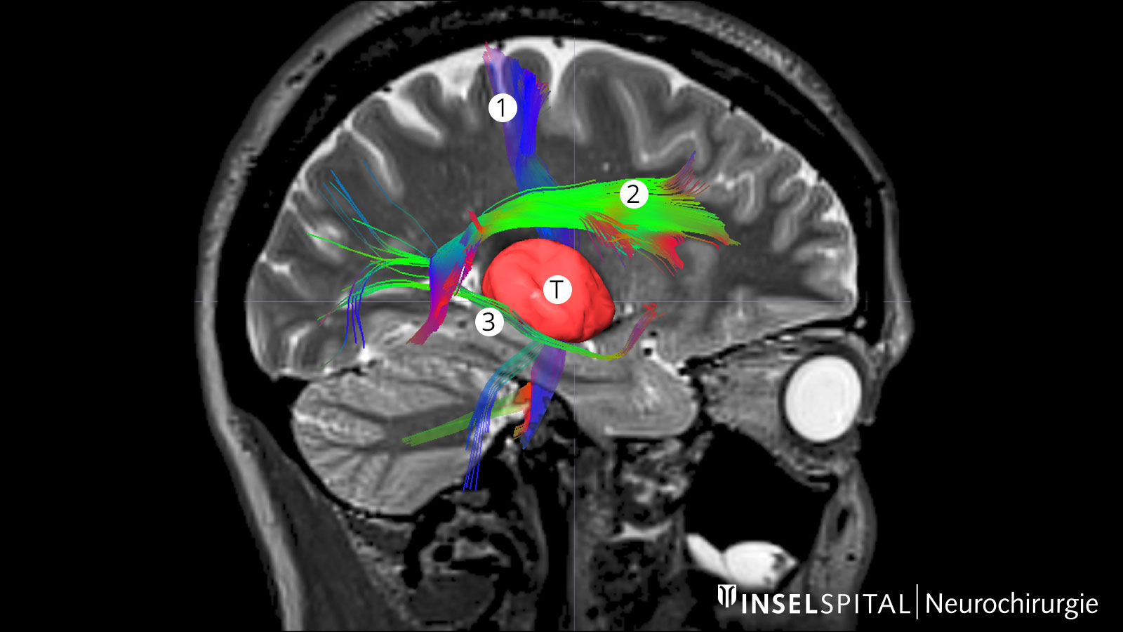 ​Fiber-Tracking-Aufnahme mit farbig markierter Bewegungsbahn, Sprachbahn und Sehbahn im Verhältnis zum Tumor