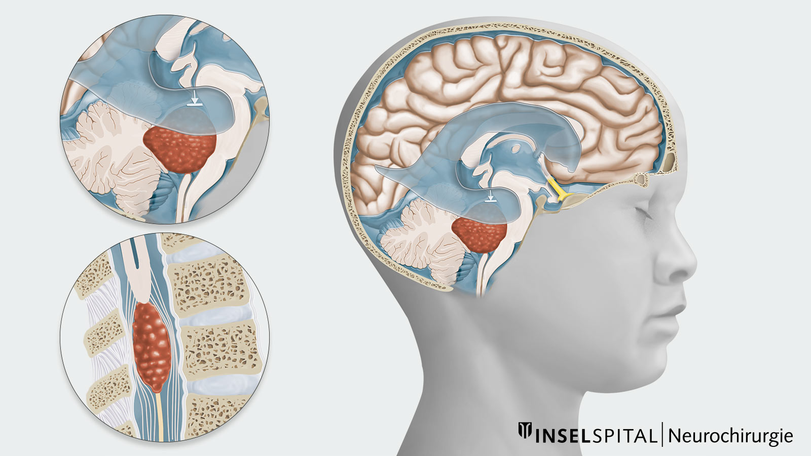 Overview drawing and 2 detailed drawings of an ependymoma blocking the CSF outflow