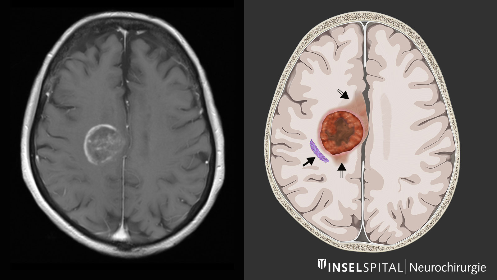 Glioblastom im MRI-Bild und als Zeichnung mit der im MRI unsichtbaren Infiltrationszone und Bewegungsbahn