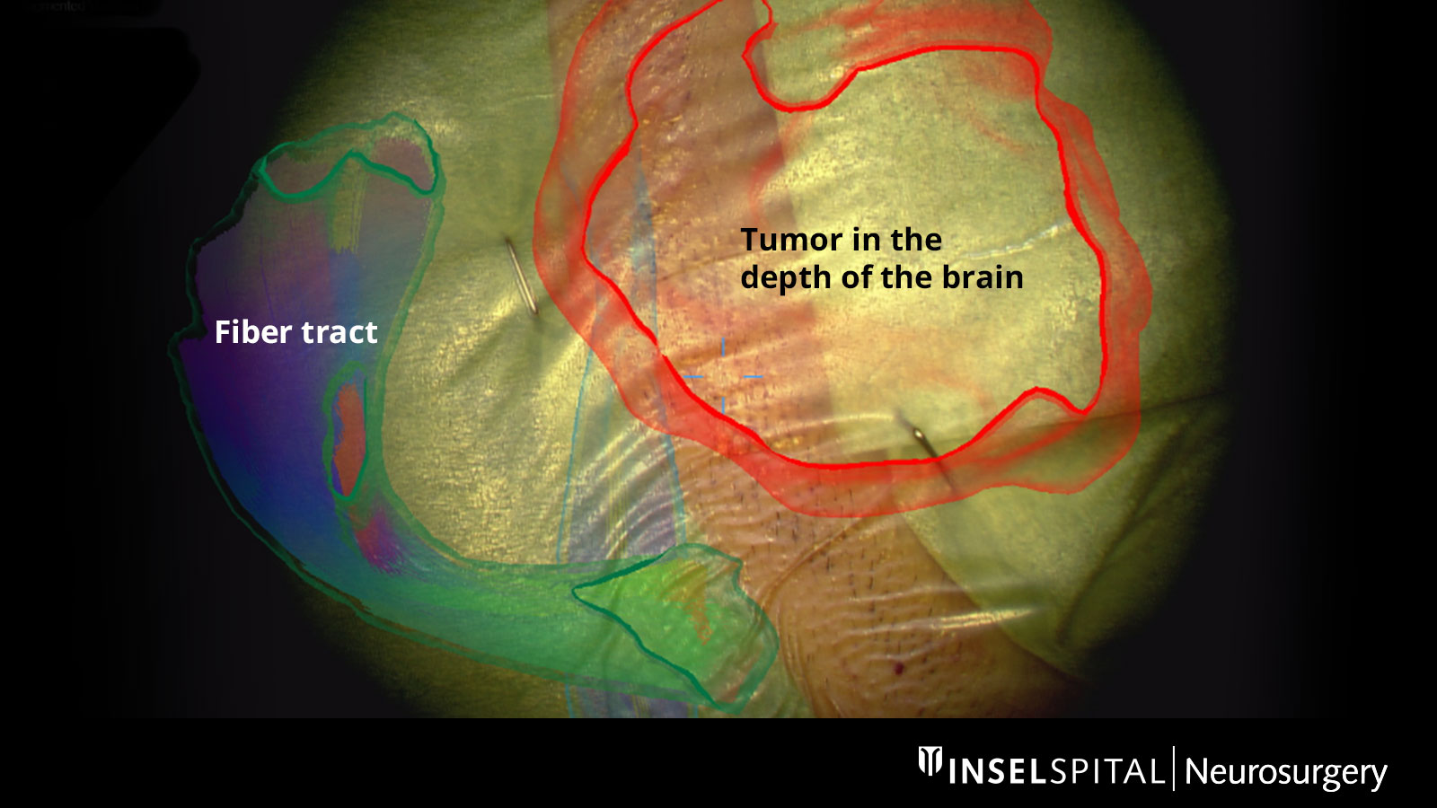 Skull image with colored structures of tumor and fiber tracts superimposed by AR