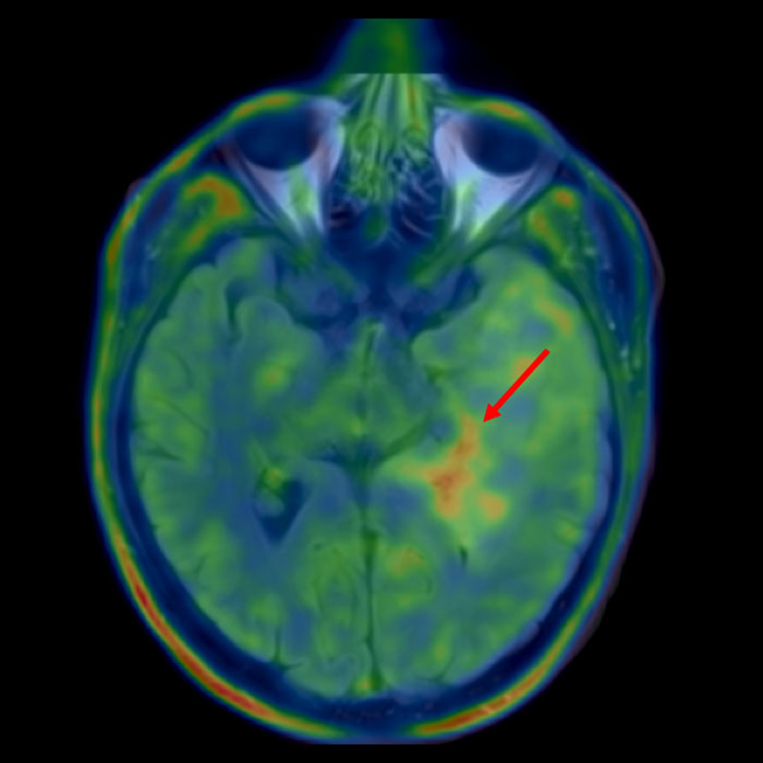 FET-PET-Daten zeigen ein gutes Ziel für eine Biopsie