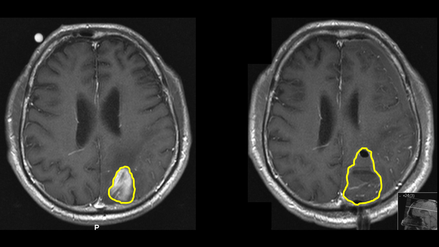 2 MRI-Bilder im Vergleich: Tumor vor OP und der mit 5-ALA tatsächlich entfernte Tumor