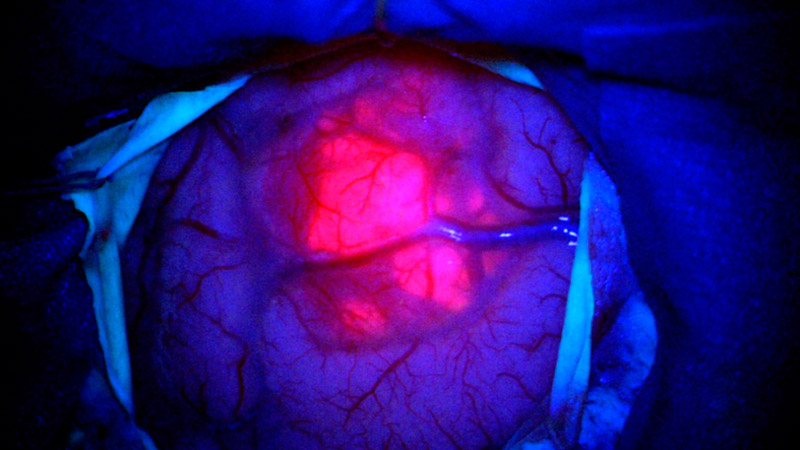 5-ALA-Fluoreszenz zeigt rötlich leuchtenden Tumor