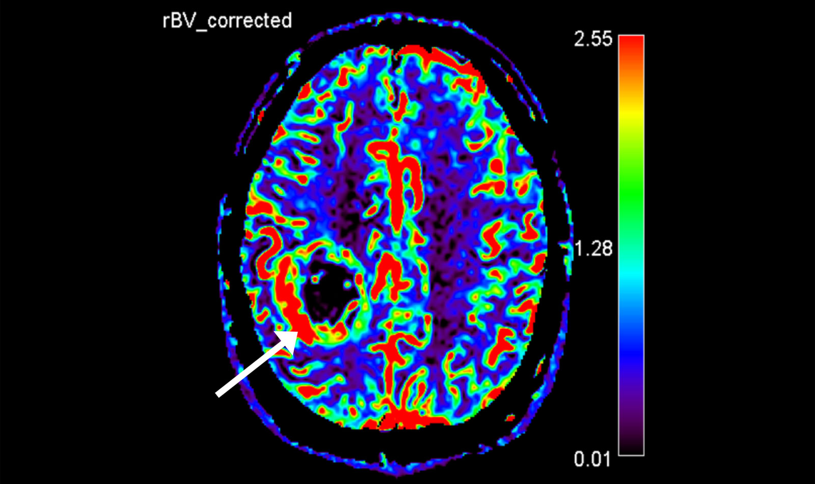 MRI with perfusion sequence shows increased blood flow in the area of the tumor